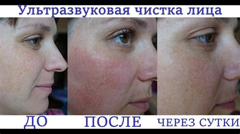 Ультразвуковая чистка лица в домашних условиях - YouTube