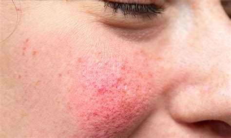 Generic and oncologic dermatitis differences - Oncos