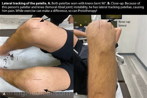 Surgery and non-surgical treatments for chronic knee cap dislocation ...