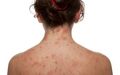 Alergia al sol remedios caseros recomendados