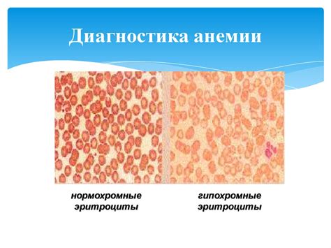 Железодефицитная анемия у детей - презентация онлайн