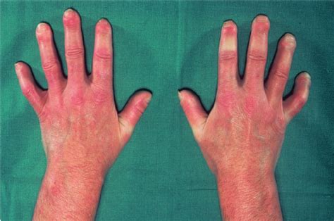 Nodular swelling of upper eyelid; Roasi Dorfman | Download Scientific ...