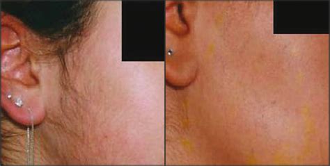 Permanent Hair Removal - Menu