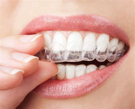 teeth whitening kit custom whitening trays coolum dentist