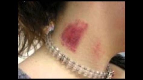 how to get rid of a hickey : how to get rid of a hickey fast | how do ...