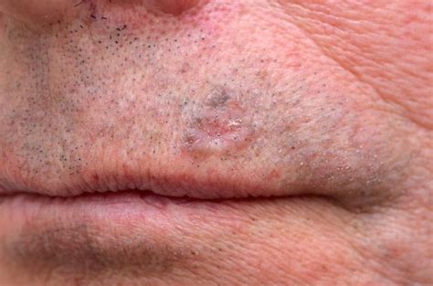 Common Skin Cancers (BCC & SCC) - Dr Stretch