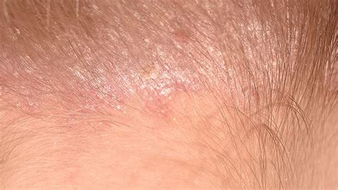 Fast Five Quiz: Scalp Psoriasis Overview