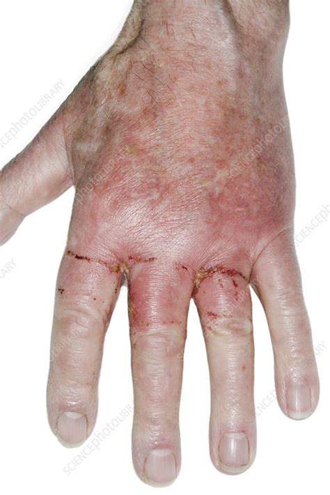 infected acid burns stock image  science photo library