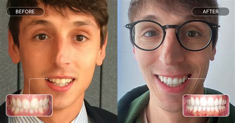 Antes E Depois Do Aparelho - Aparelho ortodôntico: antes e depois de usar ortodontia 🦷
