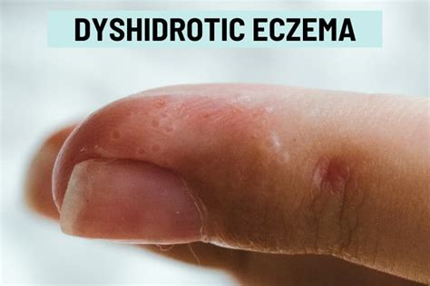 Dyshidrotic Eczema: What causes these summer finger bumps?