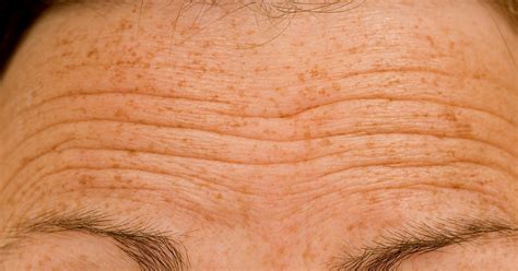 Why Men's Forehead Wrinkles Are Worse and How to Treat the Problem