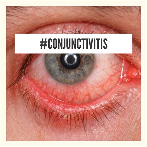 Conjunctivitis Signs