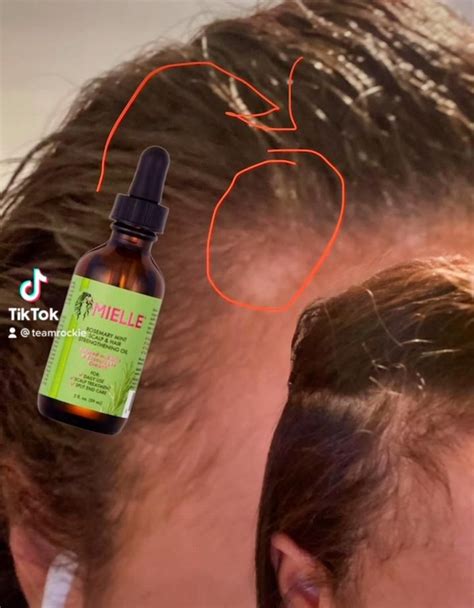 thinning hairline [Video] | Hair care tools, Thinning hairline, Hair wrap