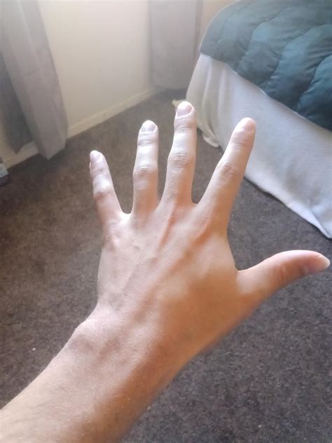 Does this look like atrophy or is my hand just skinny : r/MuscleTwitch