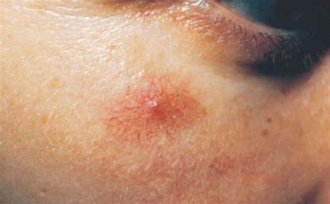 Advanced Electrical Epilation — Nataliya Robinson Health & Skincare ...