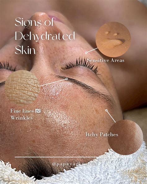 Papaya - 💧 Dehydrated or Dry: The Skin Dilemma! Dehydrated skin often