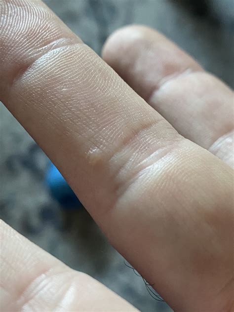 [Misc] A few small warts recently appearing on hands - any idea what