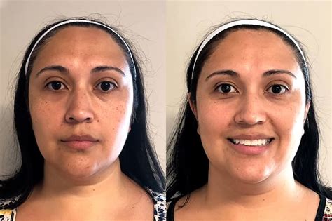 Microneedling Before and After Photos - Fresh Face + Eye in Greater NYC