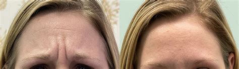 Botox, Patient 1 - LIV Wellness Lounge, Inc