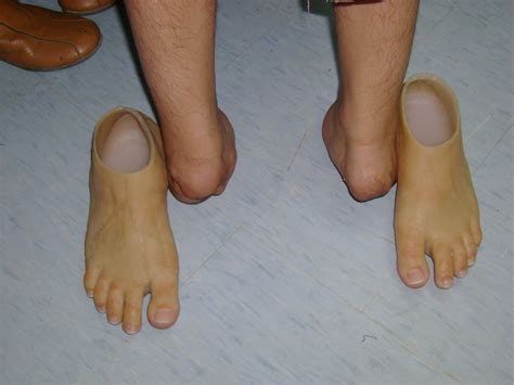 Prosthetic Foot Types - Design Talk