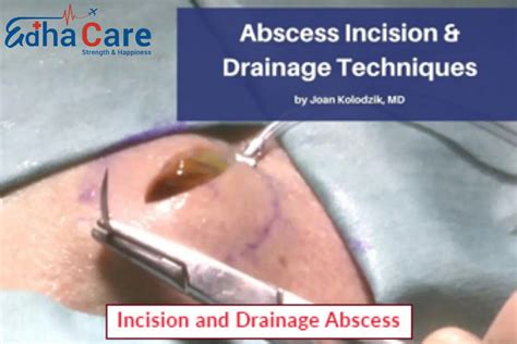 Incision and Drainage Abscess | Incision and Drainage Procedure
