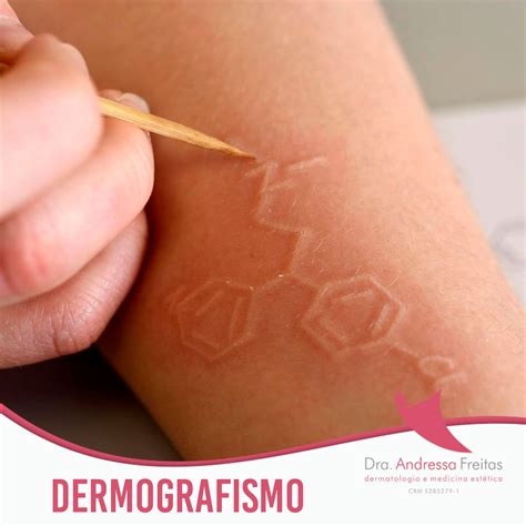 DERMOGRAFISMO: O QUE É? Um tipo... - Dra. Andressa Freitas