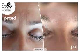 akupunktura kosmetyczna twarzy krakow