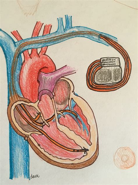 bi ventricular pacemaker illustration ecg guru instructor resources