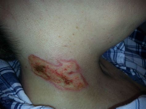 2nd-Degree Burns: Photos, Causes, Treatment