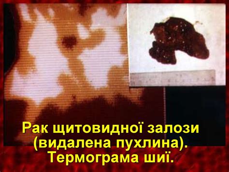 Захворювання щитоподібної залози - презентация онлайн