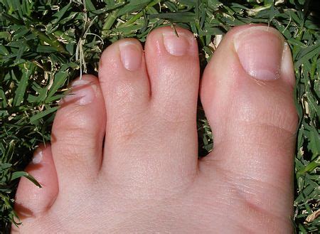 Webbed toes - Wikipedia