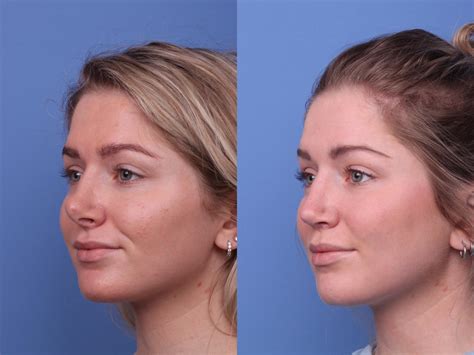 How Much Does It Cost To Have Plastic Surgery On Your Nose at Willie ...