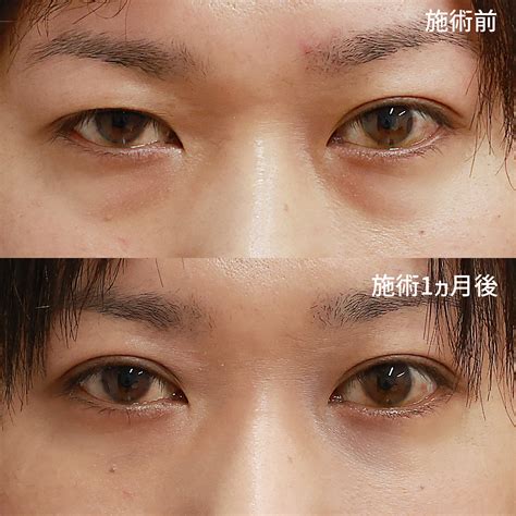 目片方小さい, 片目だけ二重 直す – DentalCoalition