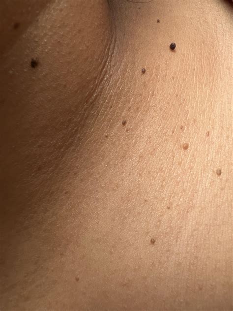 Skin tags- how to get rid of skin tags? : r/30PlusSkinCare