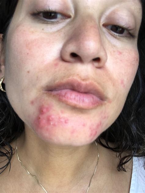 Under Chin Acne