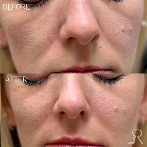 Cheek Fillers Before and Afters | Roberts Aesthetics and Wellness