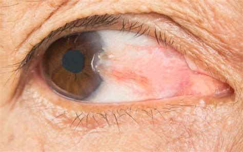 pterygium gejala penyebab  mengobati