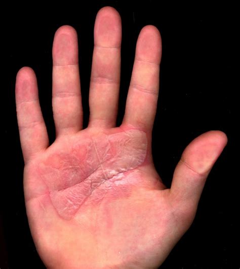 degreaser hand burn  katherine roosa blog