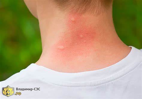 Фото постельных клопов крупным планом | Блог службы «Владимир СЭС»