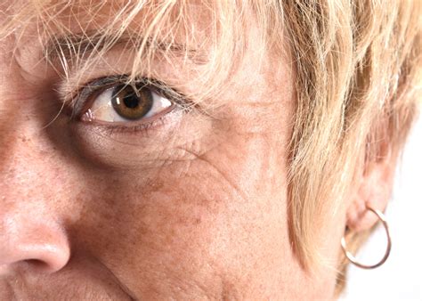 treatments  ageing skin york katrina tootell aesthetics