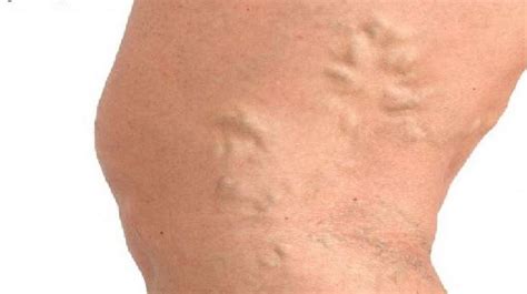 aching legs   treatments  aching legs