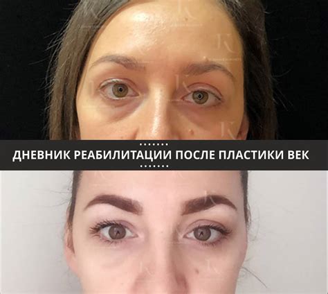 Осложнения после блефаропластики | Последствия после блефаропластики