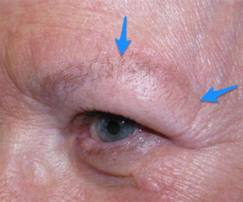 direct brow lift incisional healing woolfson eye institute