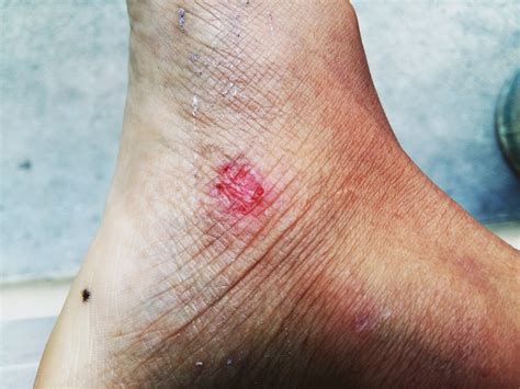 Ulcers Of The Skin