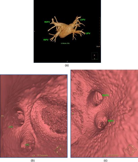 normal pulmonary venous anatomy volume rendered image  lt atrium