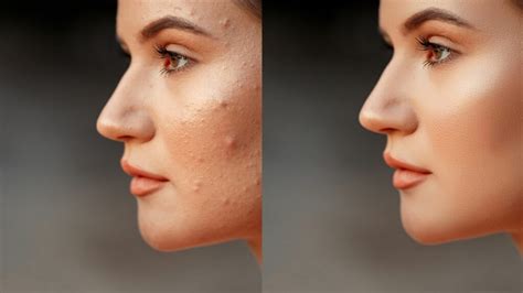 Korean Skincare Routine for Acne: A Comprehensive Guide