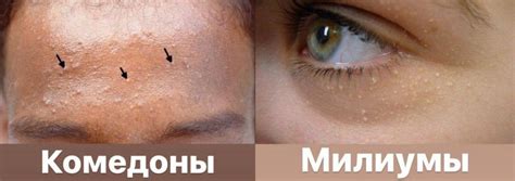 Как избавиться от закрытых комедонов: проверенные способы и рекомендации