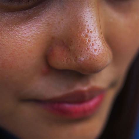oily skin  prevention treatments ro