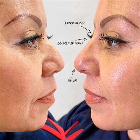 NoseFix: Filler
