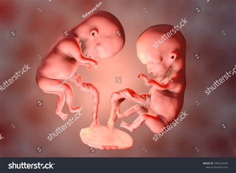 Gemeos Na Mesma Placenta - NAZAEDU
